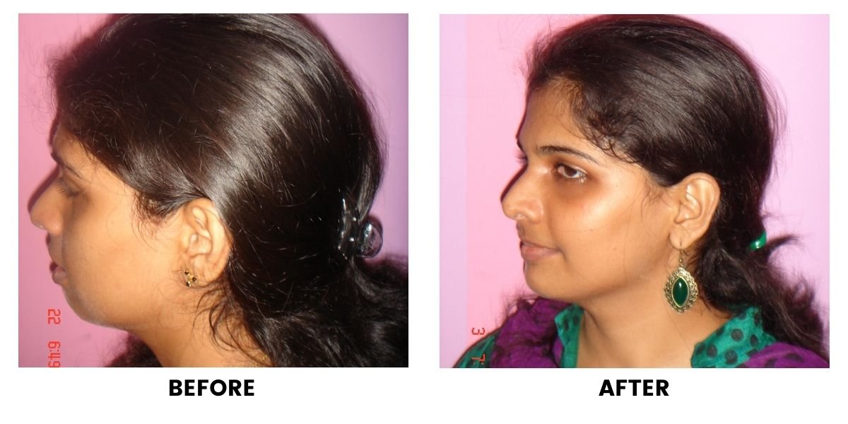 Before and after jaw surgery: plate 3 of 3 from the practice’s own record, the patient before treatment on the left and after treatment on the right.
