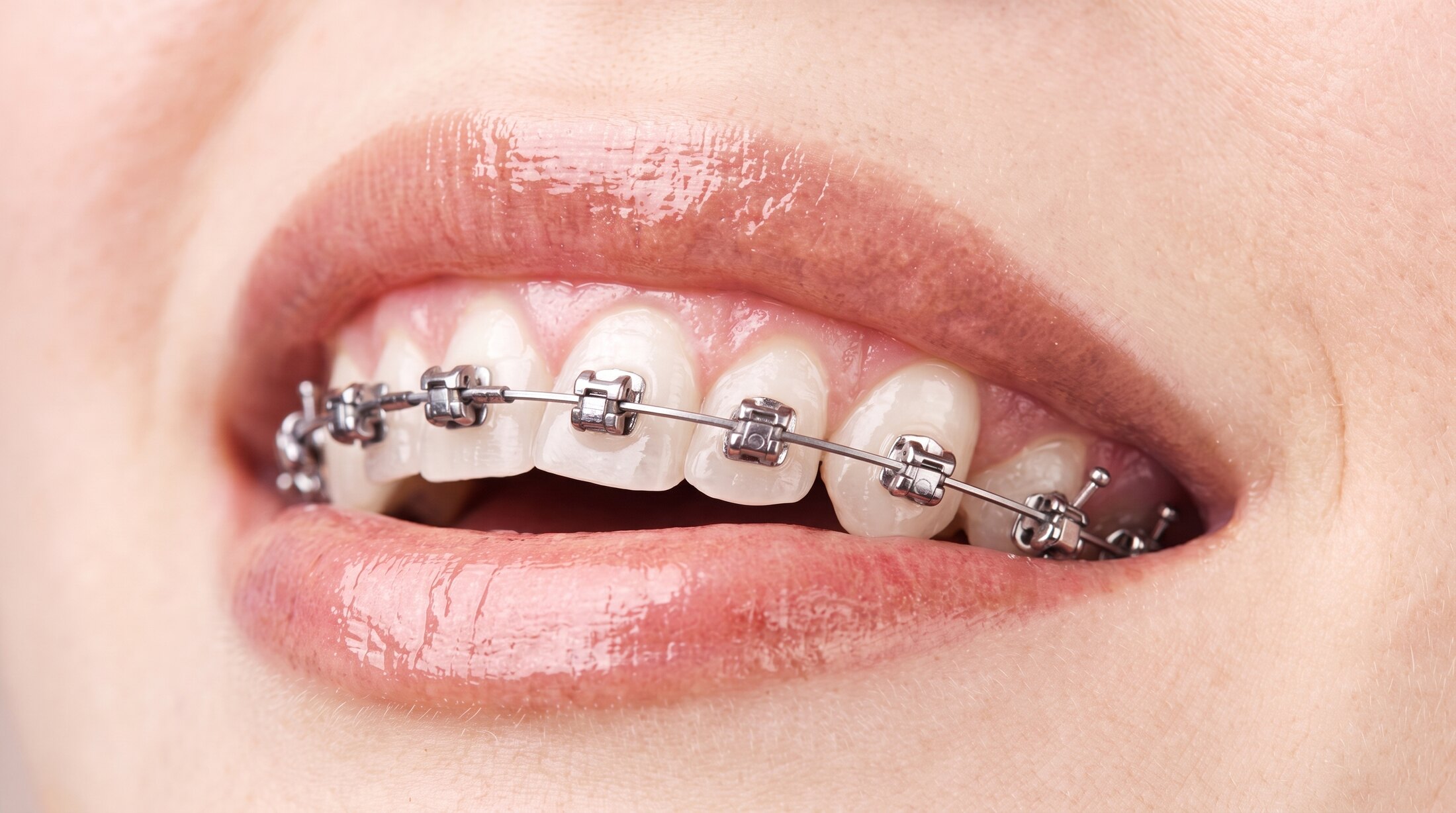 A close-up of a part-open mouth showing metal braces, brackets and an archwire, fitted across the upper teeth.