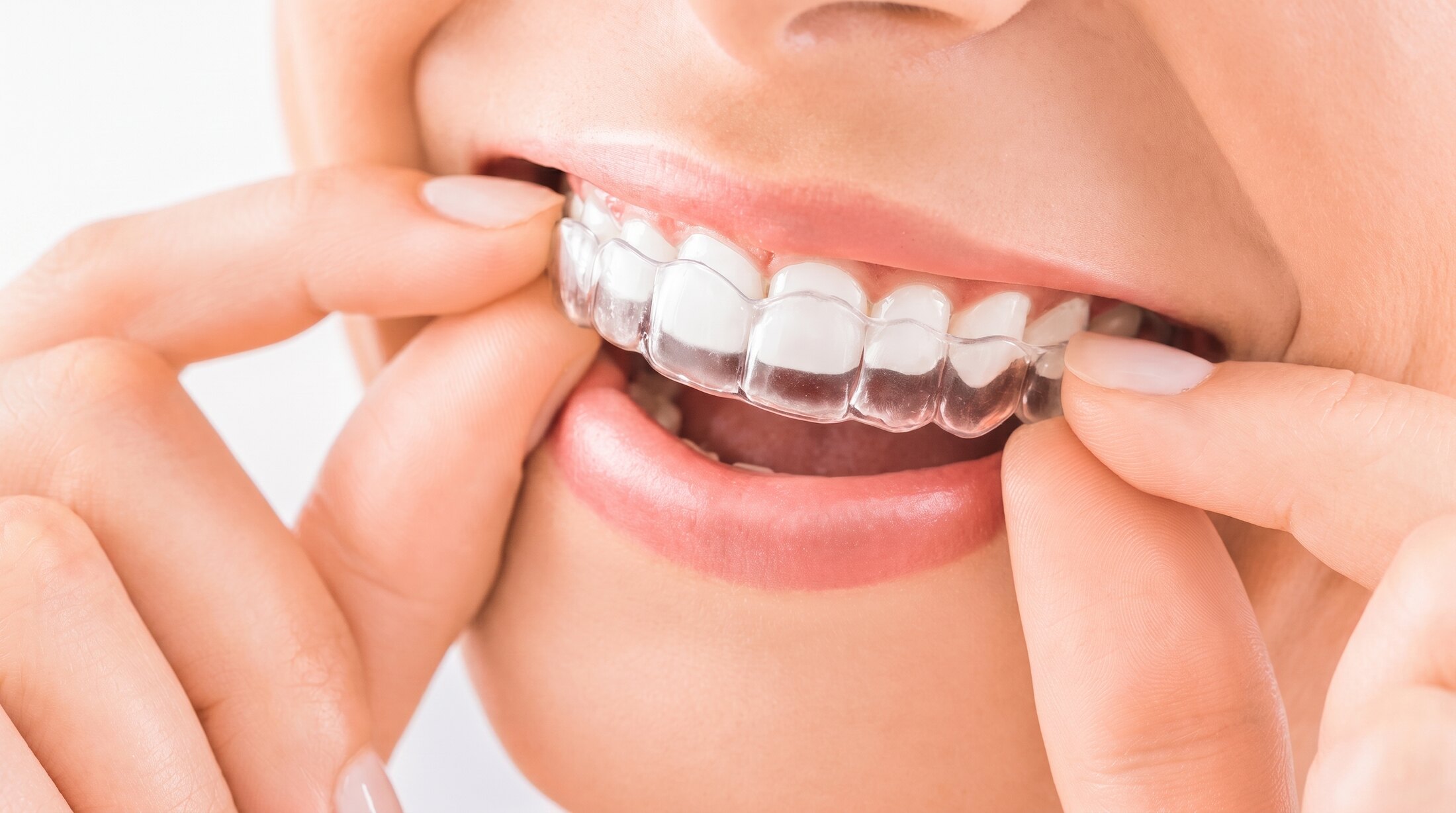A clear removable aligner being eased into place over the upper teeth with both hands.