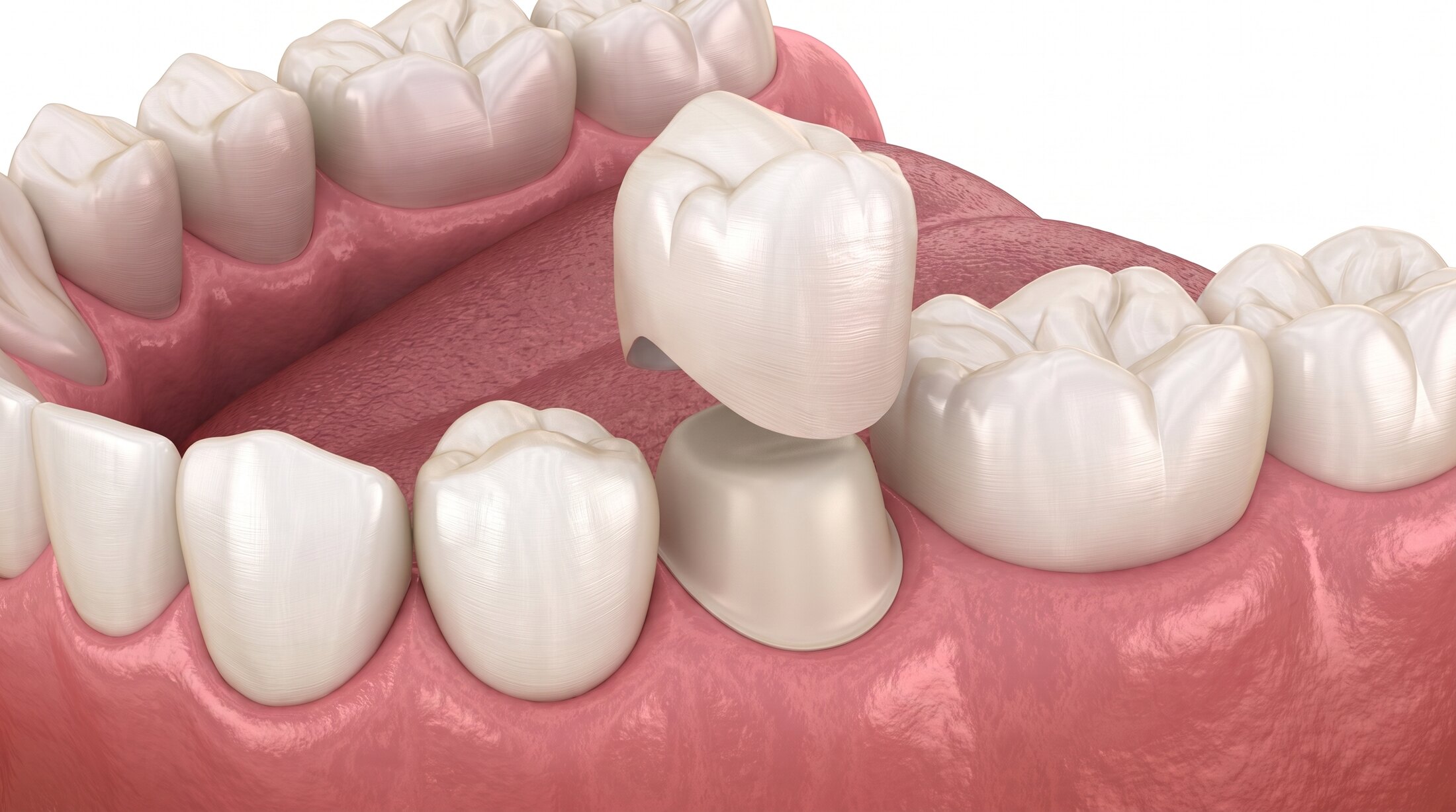 An illustration of a dental crown being lowered onto a prepared tooth in the lower arch.
