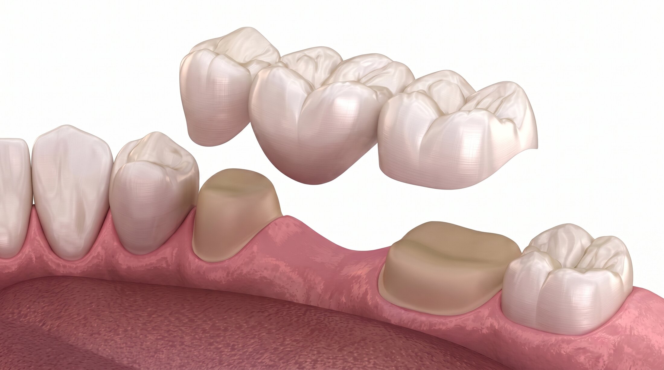 An illustration of a dental bridge held above the two prepared teeth it will be seated on.