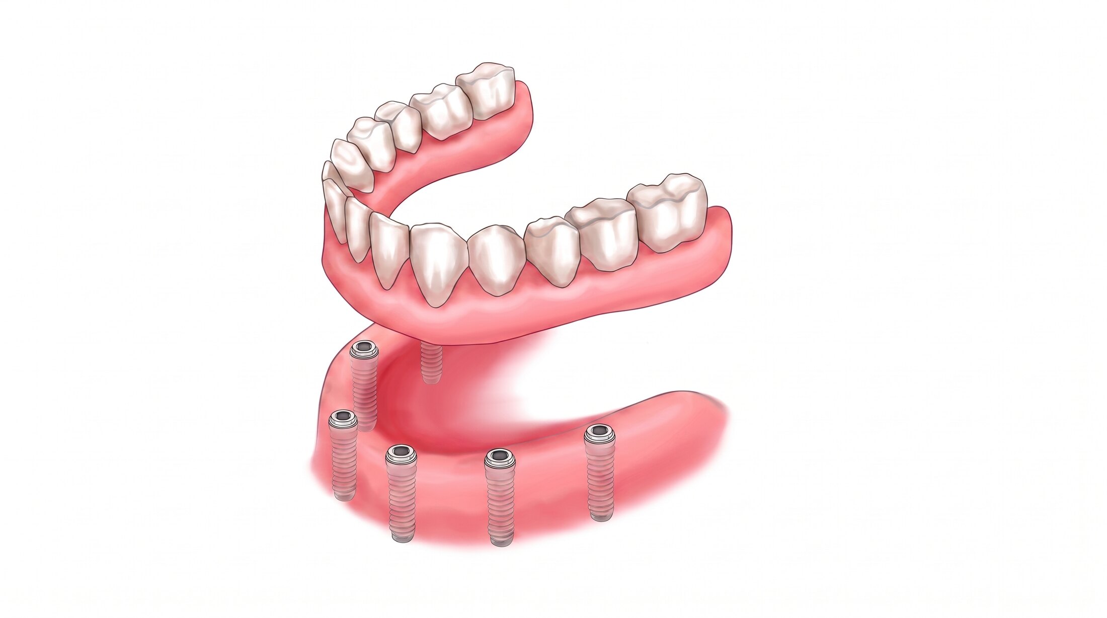 An illustration of an implant-supported lower denture lifted clear of the implants it clips onto.