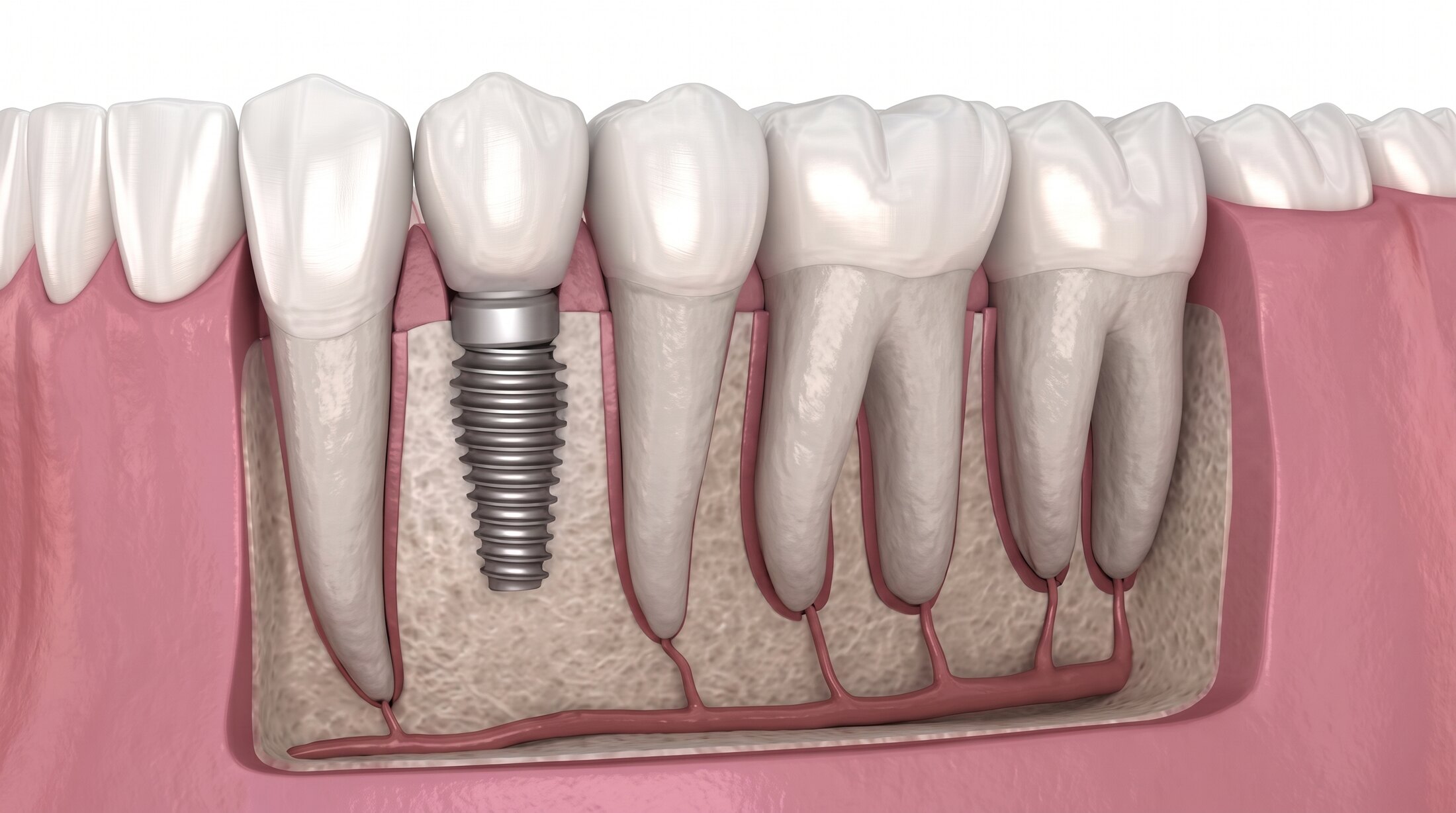 A cutaway illustration of a single dental implant seated in the jawbone beside the roots of the natural teeth.