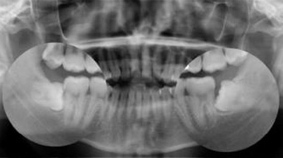 A panoramic radiograph of the upper and lower jaws showing the full set of teeth, including the wisdom teeth at the back.