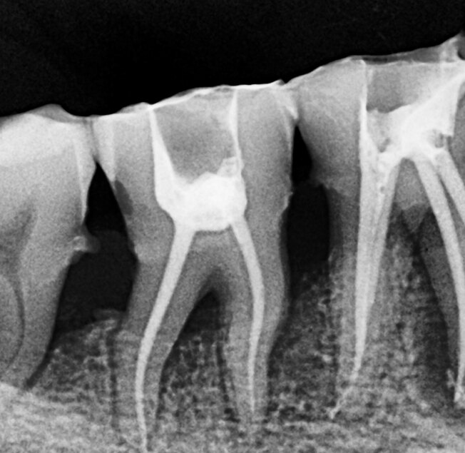 A radiograph of the same two molar teeth after root canal treatment, the filled canals visible as bright lines running down each root.