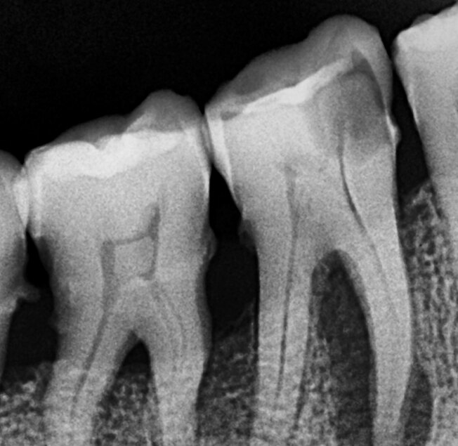 A close radiograph of two molar teeth before root canal treatment.