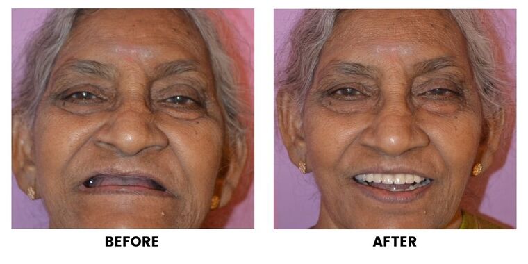 Before and after: an elderly patient with missing upper teeth, and the same patient smiling with a complete set.
