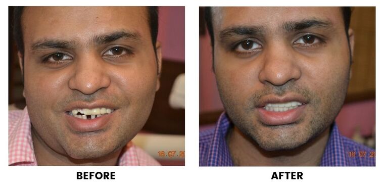 Before and after: a man with a missing upper front tooth, and the same smile with the gap closed.