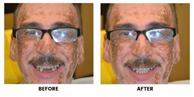 Before and after: a man with worn and gapped upper front teeth, and the same smile made even.