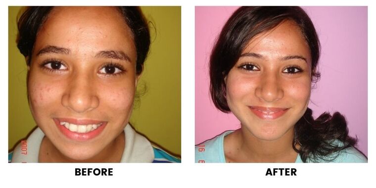 Before and after: a girl with uneven front teeth, and the same smile with the teeth level.