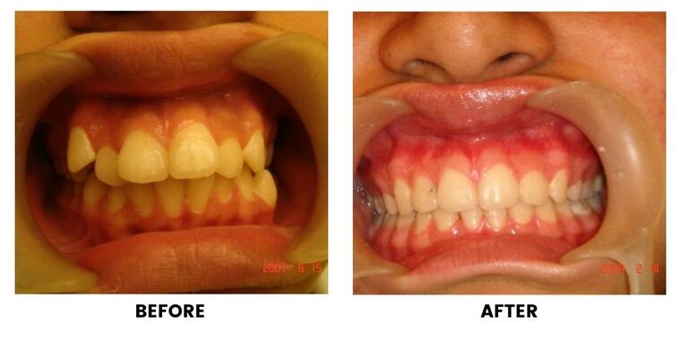 Before and after: a close view of crowded, discoloured front teeth, and the same teeth aligned and clean.