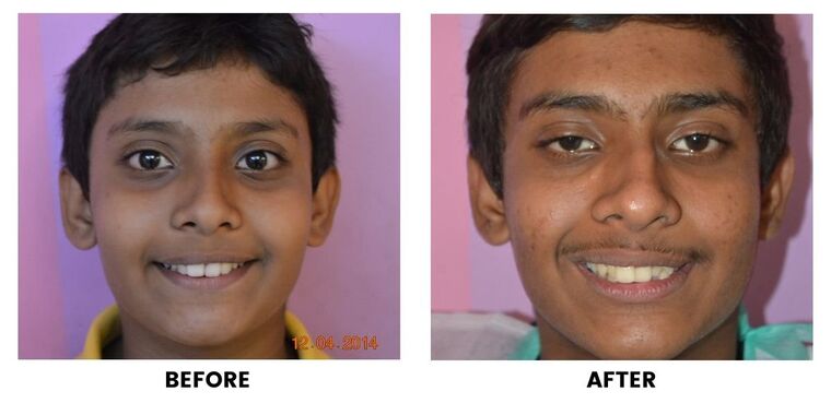 Before and after: a boy with protruding upper teeth, and the same smile with the teeth brought into line.
