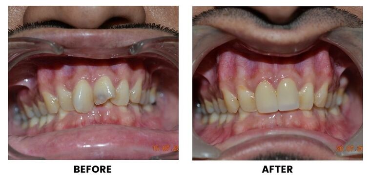 Before and after: a close view of crowded upper front teeth, and the same teeth aligned.
