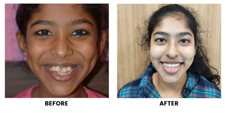 Before and after: a young woman with an uneven smile, and the same smile made even.