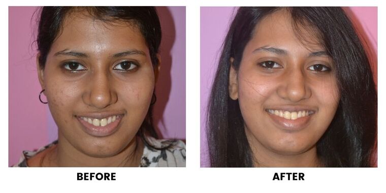Before and after: a young woman before and after orthodontic treatment.