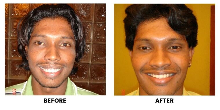 Before and after: a man before and after dental treatment, smiling in both.