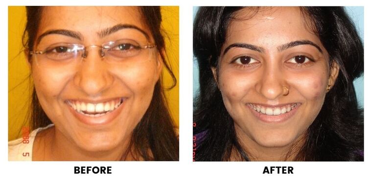 Before and after: a woman in glasses before and after dental treatment.