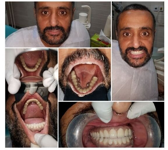 A five-part record of the finished result: the patient smiling, the new upper and lower teeth photographed from above and below, and close views of the completed work in the mouth.