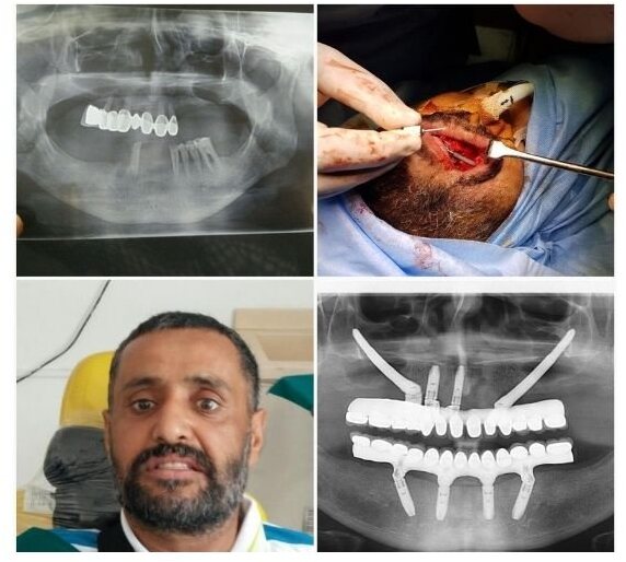 A four-part clinical record running from diagnosis through surgery: a panoramic radiograph showing only a few teeth left in the jaw, a photograph taken during implant surgery, a photograph of the patient, and a second panoramic radiograph showing the implants in place.