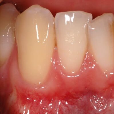 The same gum margins after treatment, pale pink and firm.