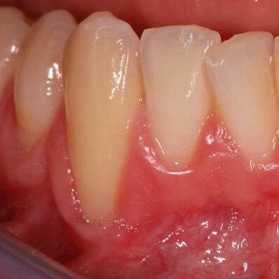 A close view of the gum margins around the upper front teeth, reddened and swollen.