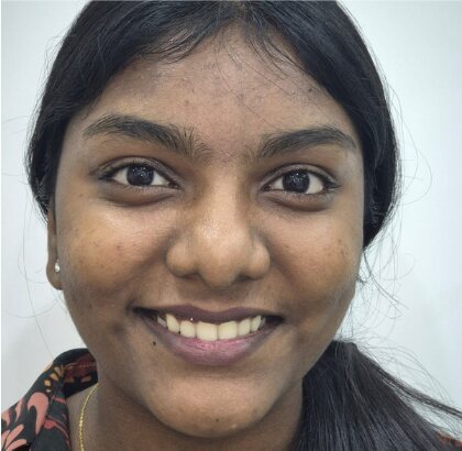 The same young woman smiling after treatment, her front teeth level.