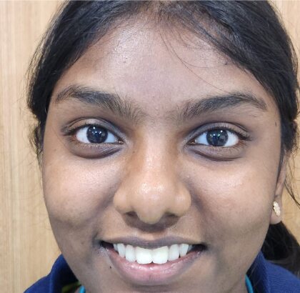 A young woman smiling before orthodontic treatment, her front teeth uneven.