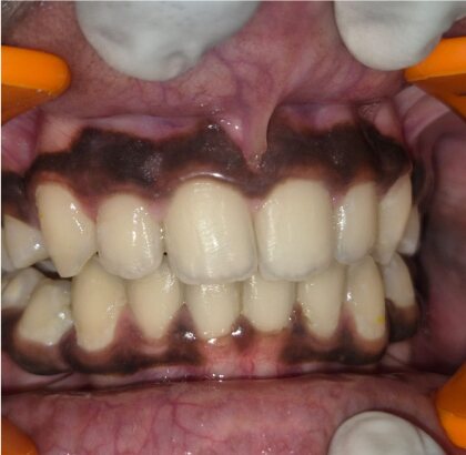 The same teeth photographed straight on after treatment.