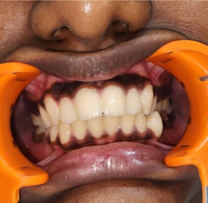 The upper and lower teeth photographed straight on, with the lips held clear, before treatment.