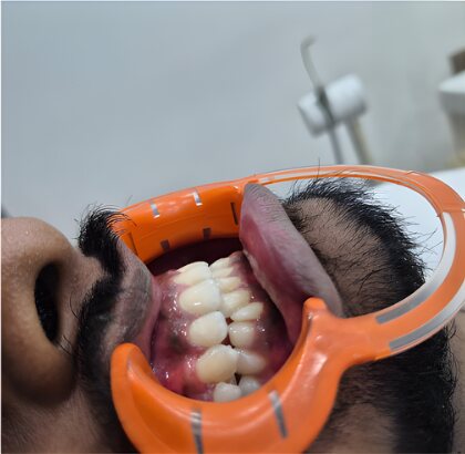 The same teeth photographed from the side after treatment.