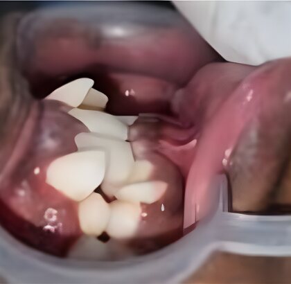 The teeth photographed from the side before treatment, the upper front teeth pushed forward.