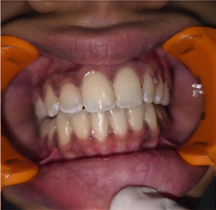 The same teeth photographed straight on after treatment.