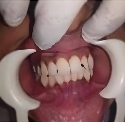 The upper and lower front teeth photographed straight on before treatment.