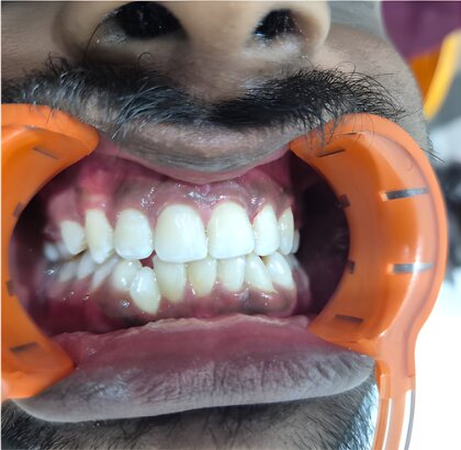 The same teeth photographed straight on after treatment.