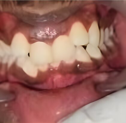 The upper and lower front teeth photographed straight on before treatment, the upper front teeth overlapping.