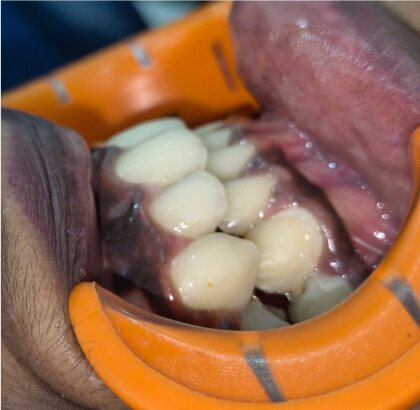 The same teeth photographed from the side after treatment.