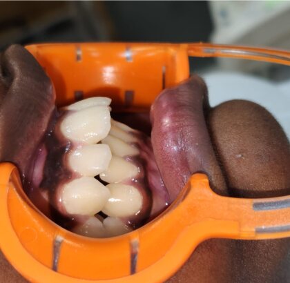 The teeth photographed from the side before treatment.