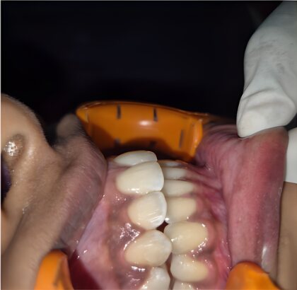 The same teeth photographed from the side after treatment.