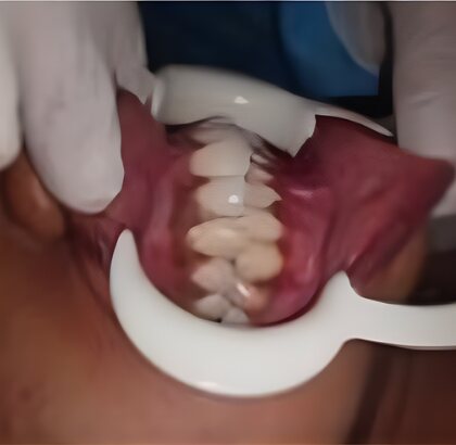 The teeth photographed from the side before treatment.