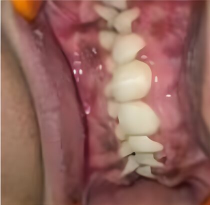 The same teeth photographed from the side after treatment.