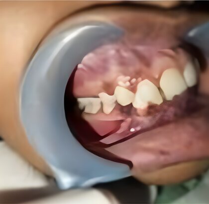 The teeth photographed from the side before treatment.