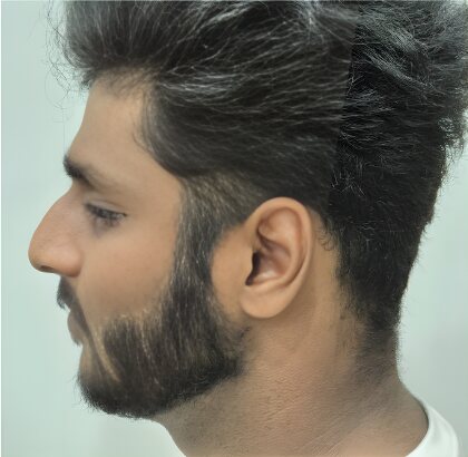 The same profile after treatment.