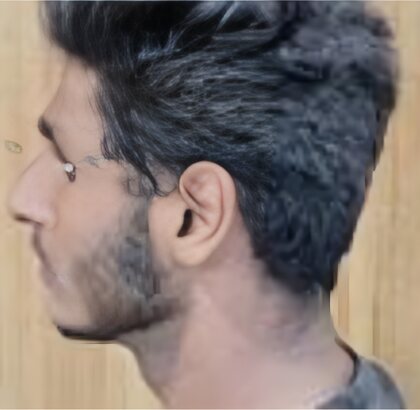 A young man's face in profile before orthodontic treatment.