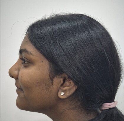 The same profile after treatment.