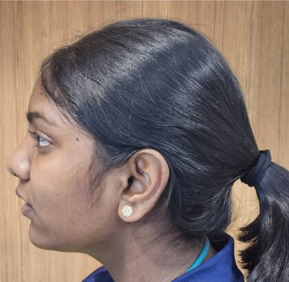A face in profile before orthodontic treatment.