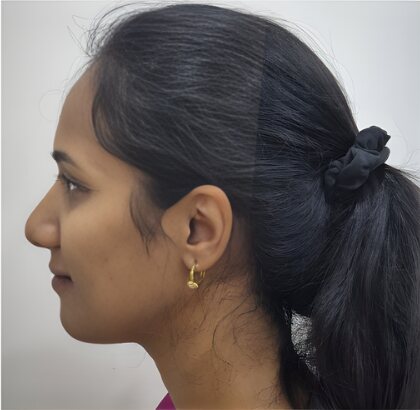 The same profile after treatment.