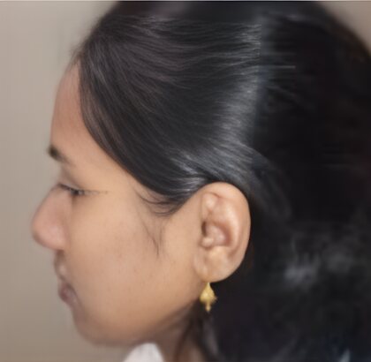 A face in profile before orthodontic treatment.