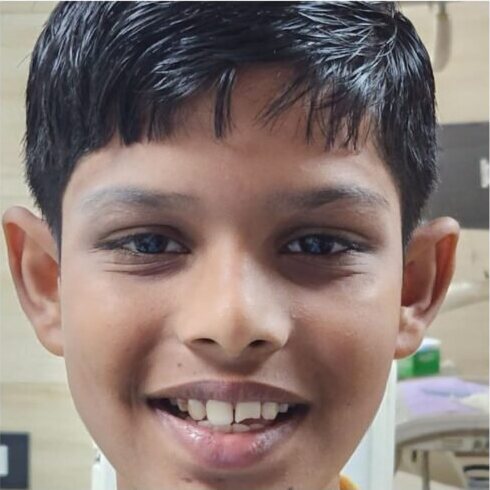 A boy smiling in the surgery, his adult front teeth partly through.