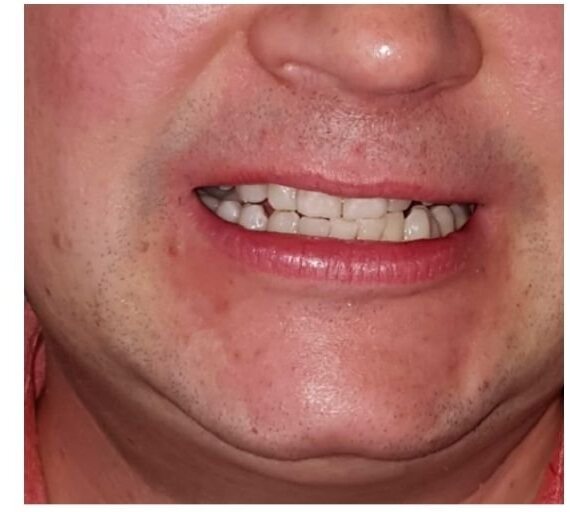 The same lower face after treatment, the swelling resolved.