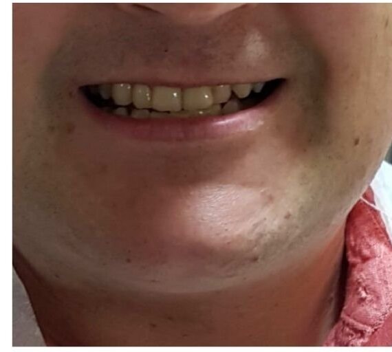 The lower face and mouth before treatment, with swelling along one side of the jaw.